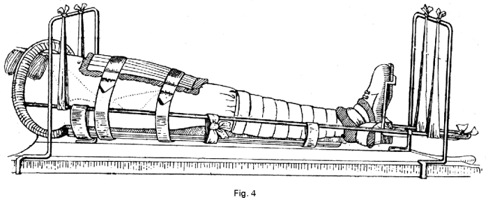 Splint thomas suspension