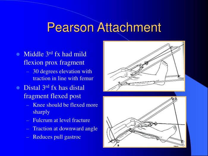 Thomas splint with pearson attachment