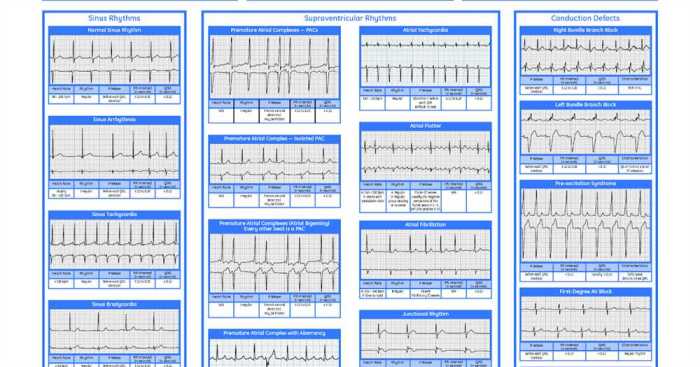 Flex ed dysrhythmia test answers